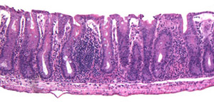 Histological section of an inflamed cecum, large intestine (Marika Kullberg)