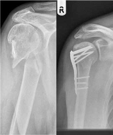 Shoulder injury and repair