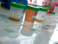 urines of schistomiasis infected patients