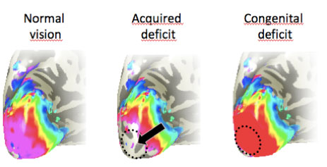 Figure 1: The mapping of the retina on the surface of the brain. Acquired loss of central vision in adulthood leads to a ‘hole’ in the map consistent with the damage to the retina.  However, if visual loss occurs before birth, as found in some congenital deficits, there appears to be a ‘filling in’ of the map.