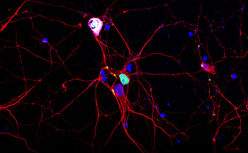 Figure 1. TDP-43 forms aggregates when over-expressed in neurones. TDP-43 (green) is a nuclear (DAPI in blue) localisation protein. However, when over-expressed in primary neurones (beta-3-tubulin, red), they form cytoplasmic aggregates which are hyperphosphorylated (magenta).