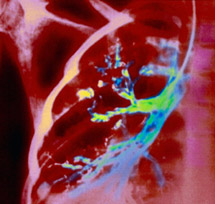 Lung image from SciencePhotoLibrary