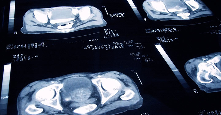An enlarged cancerous prostate is shown on a Tomography scan © istock.com/jamesbenet