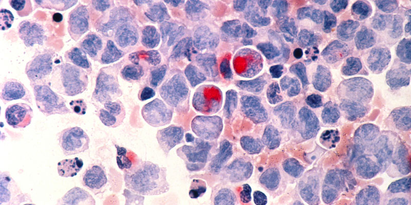Human cells with acute myelocytic leukemia (AML) in the pericardial fluid, shown with an esterase stain at 400x.